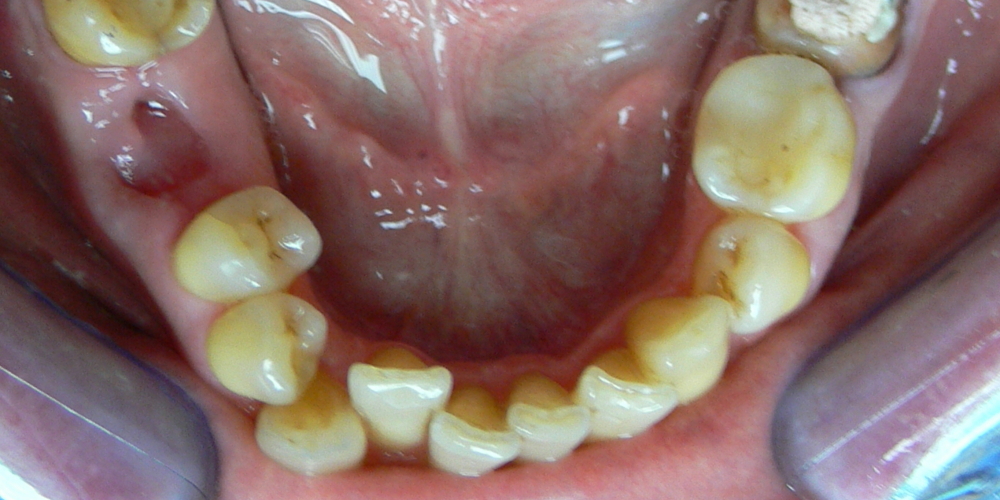 Жалобы на неровные зубы, подготовка к протезированию - фото №4