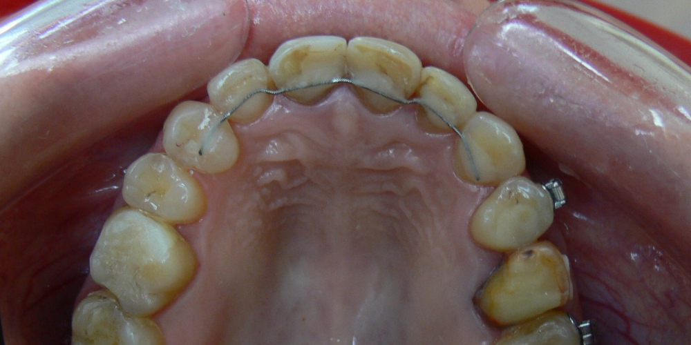 Жалобы на неровные зубы, подготовка к протезированию - фото №5