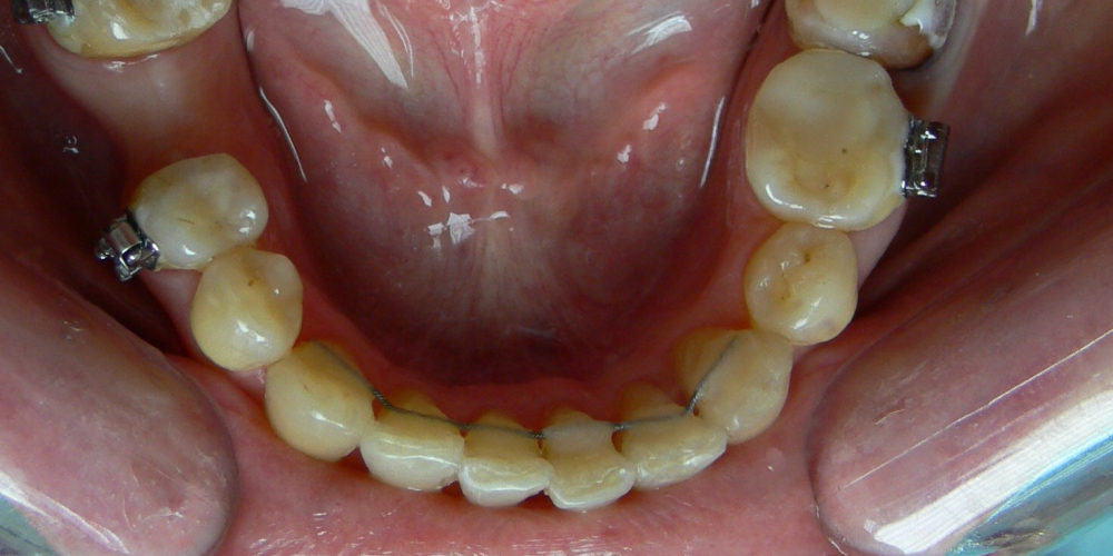 Жалобы на неровные зубы, подготовка к протезированию - фото №2