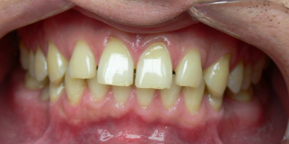 Жалобы на промежутки между зубами, не выпавшие молочные зубы на нижней челюсти - фото №1