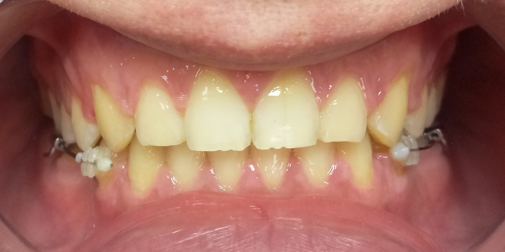 Жалобы на промежутки между зубами, не выпавшие молочные зубы на нижней челюсти - фото №6