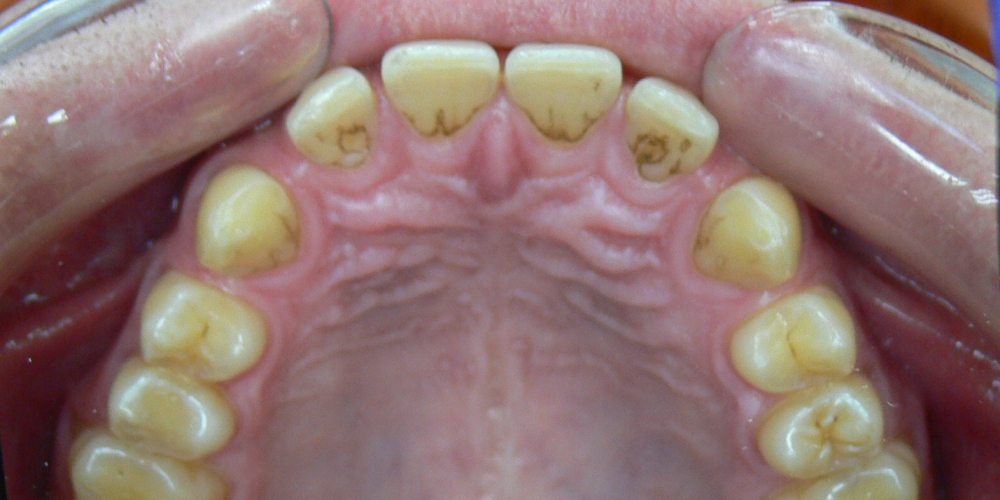 Жалобы на промежутки между зубами, не выпавшие молочные зубы на нижней челюсти - фото №3