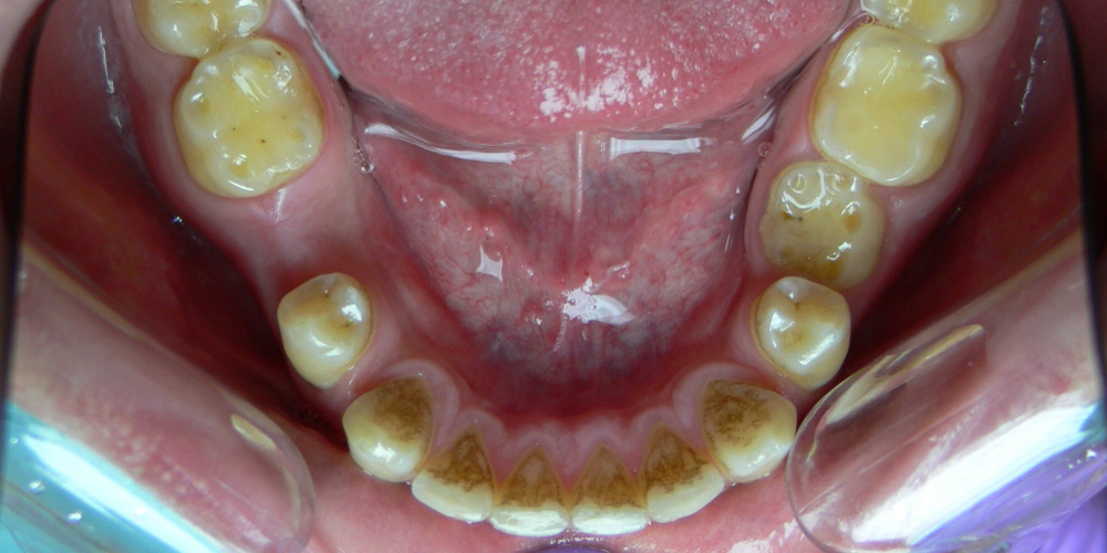 Жалобы на промежутки между зубами, не выпавшие молочные зубы на нижней челюсти - фото №4