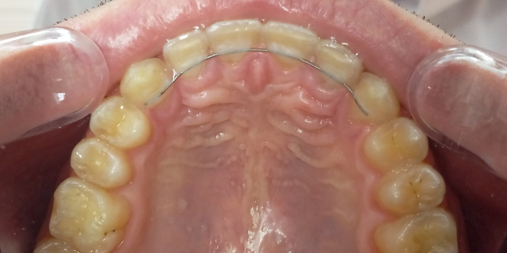 Жалобы на промежутки между зубами, не выпавшие молочные зубы на нижней челюсти - фото №5