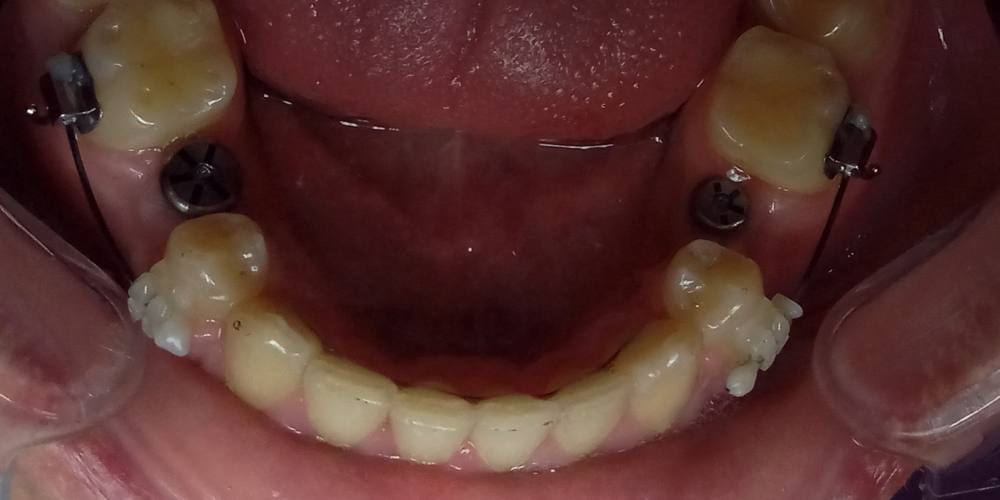Жалобы на промежутки между зубами, не выпавшие молочные зубы на нижней челюсти - фото №2
