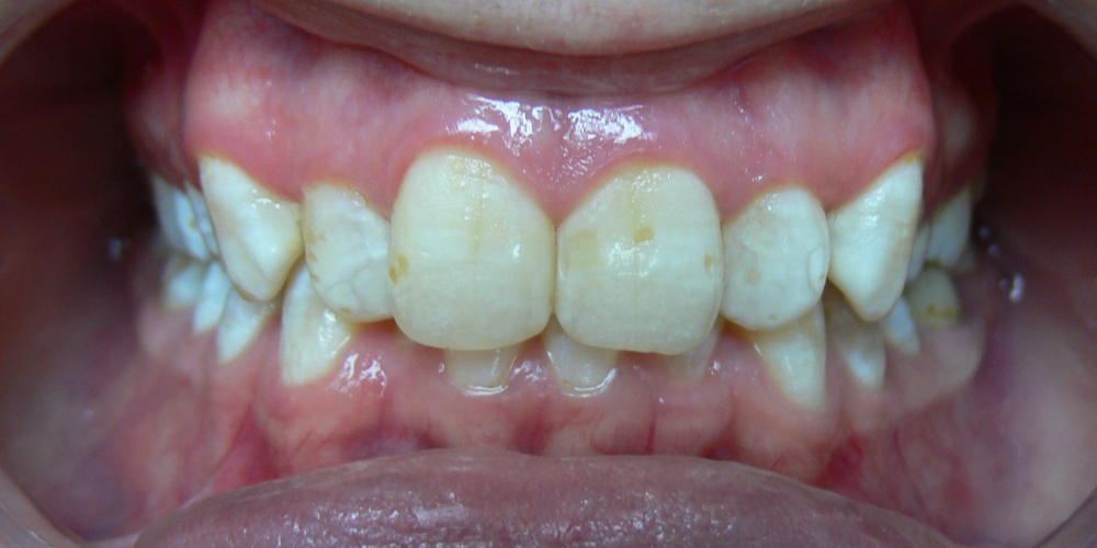 Жалобы на неровные зубы, отказ других ортодонтов ставить брекеты из-за особенности эмали (флюороз) - фото №1