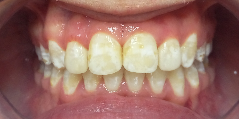 Жалобы на неровные зубы, отказ других ортодонтов ставить брекеты из-за особенности эмали (флюороз) - фото №4