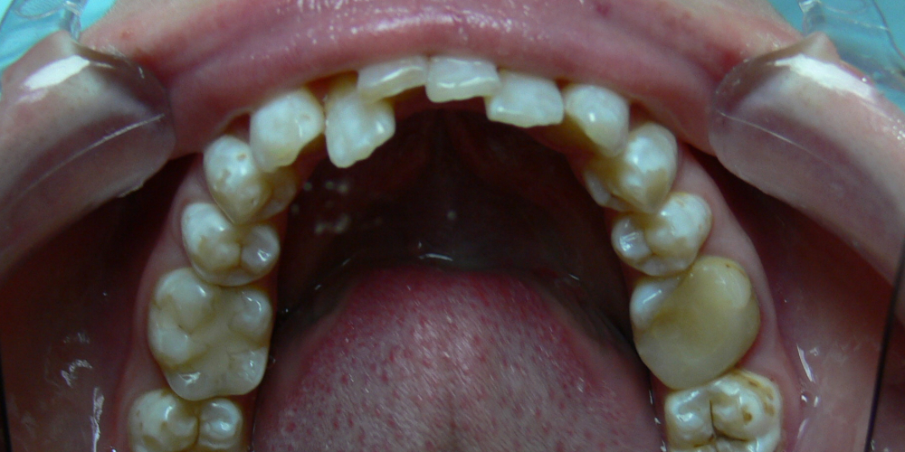 Жалобы на неровные зубы, отказ других ортодонтов ставить брекеты из-за особенности эмали (флюороз) - фото №3
