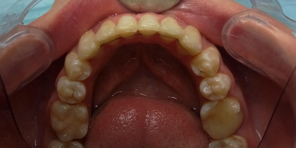 Жалобы на неровные зубы, отказ других ортодонтов ставить брекеты из-за особенности эмали (флюороз) - фото №2