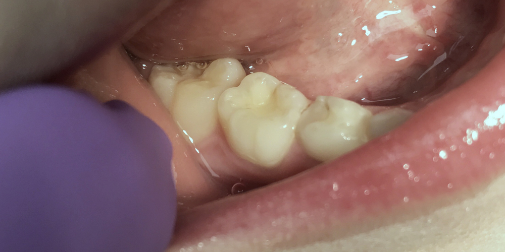 Средний кариес зуба 85 на контактной и жевательной поверхностях - фото №1