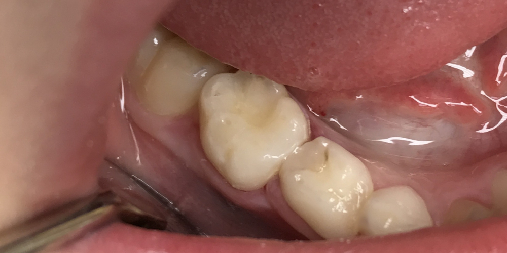 Средний кариес зуба 85 на контактной и жевательной поверхностях - фото №3