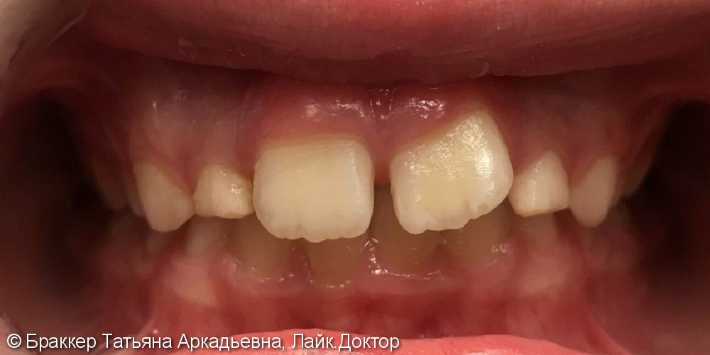 Результат исправления неровных зубов и неправильного прикуса - фото №1