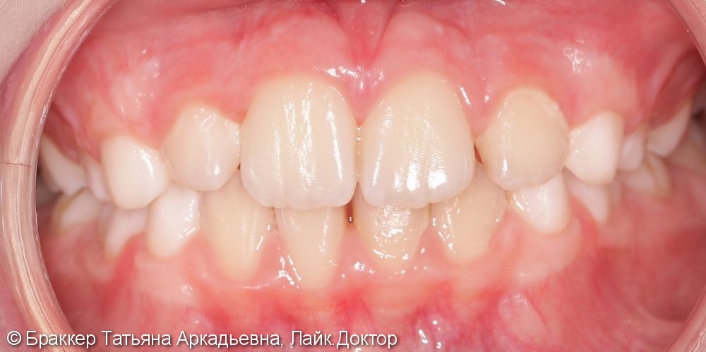 Результат исправления неровных зубов и неправильного прикуса - фото №6