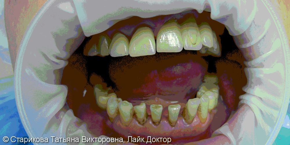 Результат отбеливания зубов - фото №1