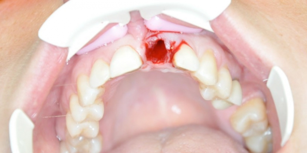 Результат установки имплантата AnyRidge на место переднего зуба - фото №1