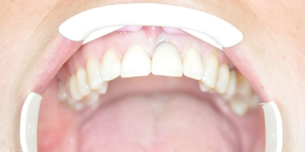 Результат установки имплантата AnyRidge на место переднего зуба - фото №3