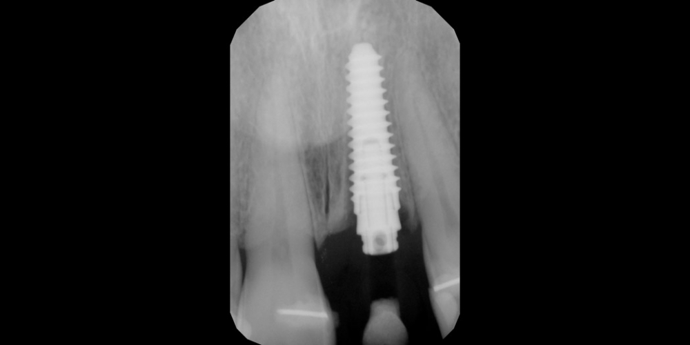 Результат установки имплантата AnyRidge на место переднего зуба - фото №2