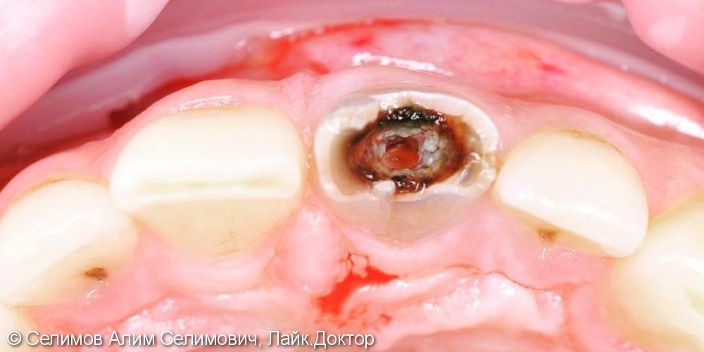Удаление зуба, имплантация и немедленная нагрузка, до и после - фото №1