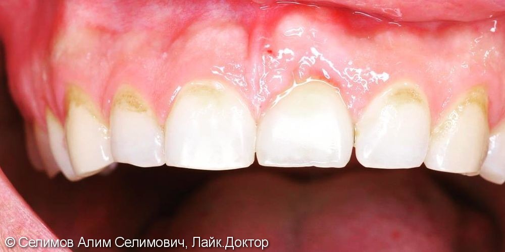 Удаление зуба, имплантация и немедленная нагрузка, до и после - фото №3
