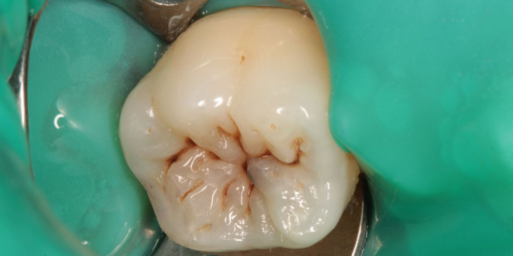 Восстановления зуба с полным сохранением анатомии зуба - фото №1