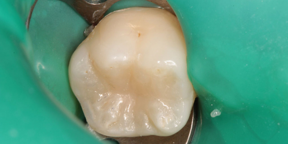 Восстановления зуба с полным сохранением анатомии зуба - фото №3