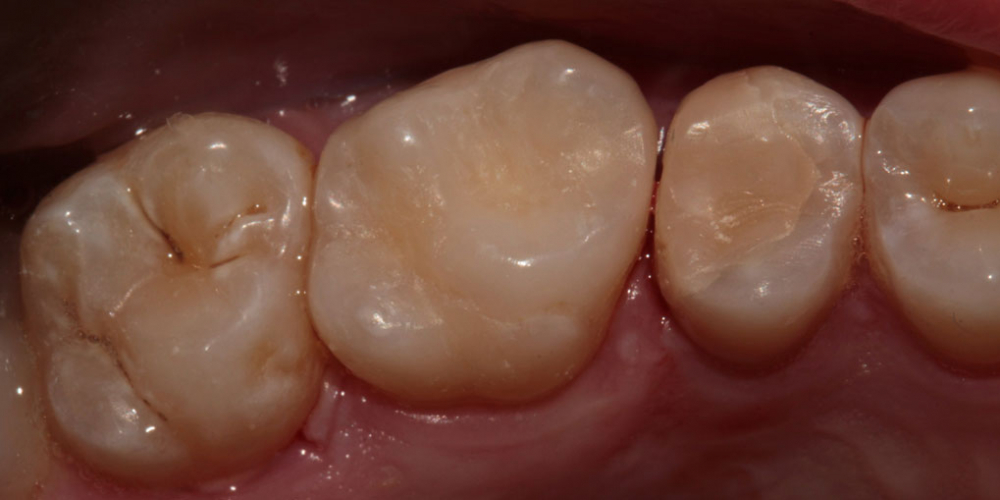 Устранение застревания пищи между зубов - фото №3