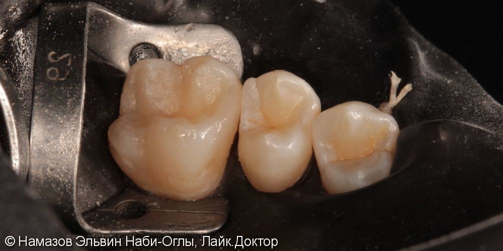 Эстетико-функциональная реставрация 2.6 зуба - фото №6