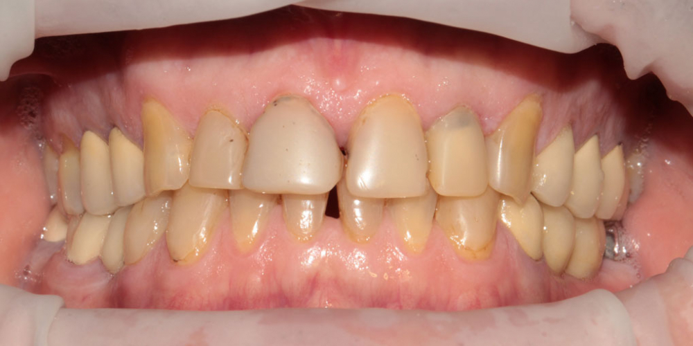Результат установки виниров на передние зубы - фото №1