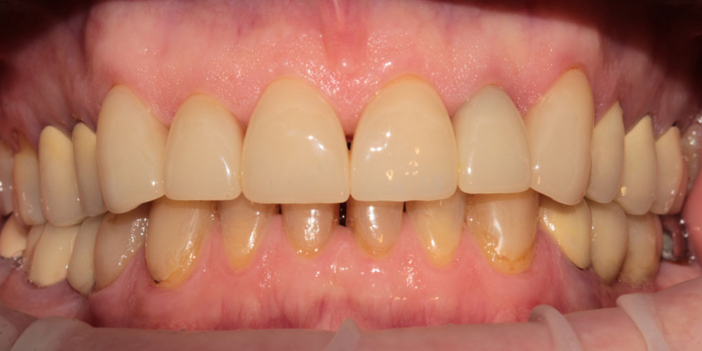 Результат установки виниров на передние зубы - фото №2