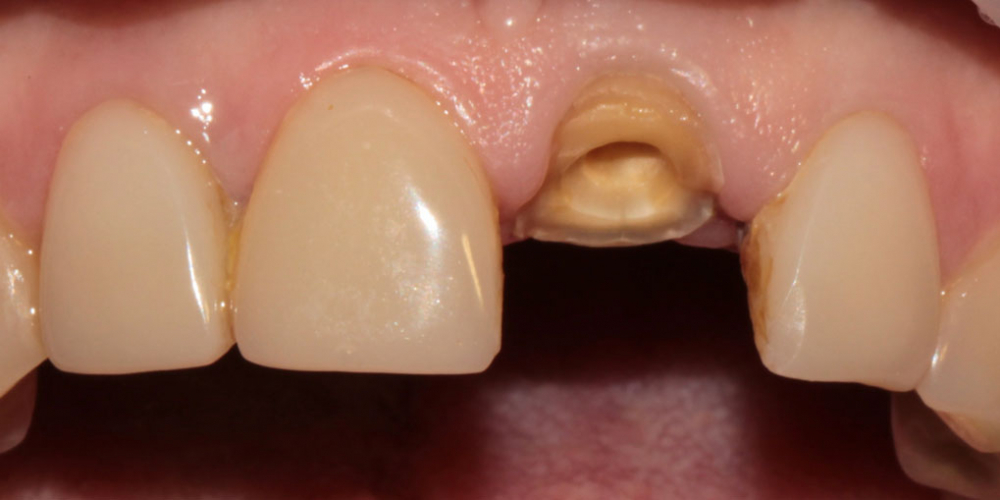 Восстановление центрального зуба вкладкой и коронкой - фото №1
