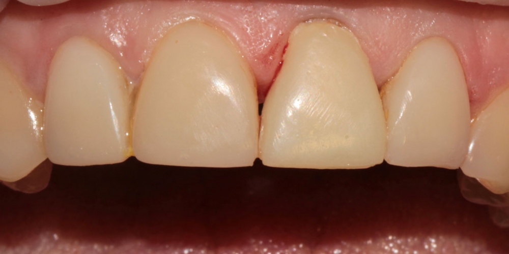 Восстановление центрального зуба вкладкой и коронкой - фото №3