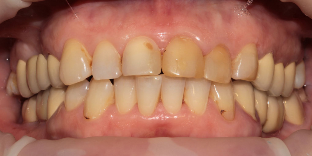 Установка керамических виниров на 6 передних зубов верхней челюсти - фото №1