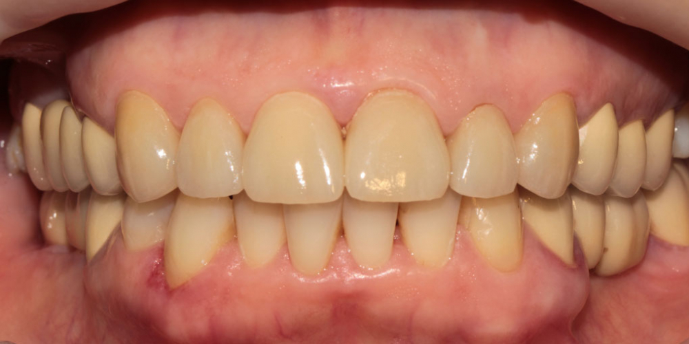 Установка керамических виниров на 6 передних зубов верхней челюсти - фото №2