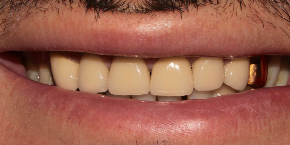 6 металлокерамических коронок на передние зубы - фото №2