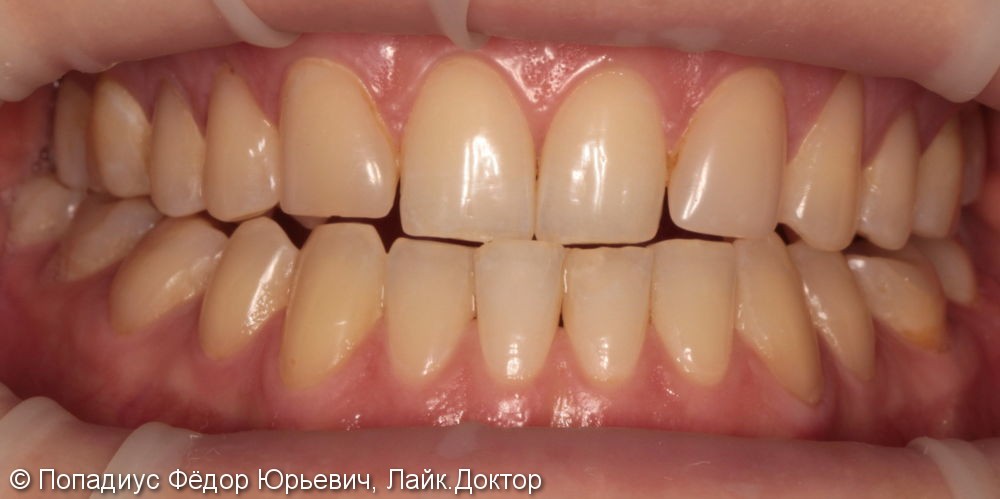 Керамические виниры, устранение недостатков ортодонтического лечения - фото №1