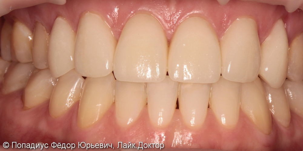 Керамические виниры, устранение недостатков ортодонтического лечения - фото №2