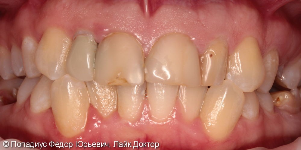Эстетическая реабилитация, не устраивает состояние верхних передних зубов - фото №1