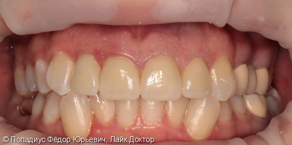 Эстетическая реабилитация, не устраивает состояние верхних передних зубов - фото №2