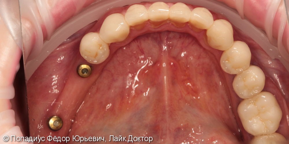Протезирование жевательных зубов на имплантатах израильской фирмы MIS - фото №1
