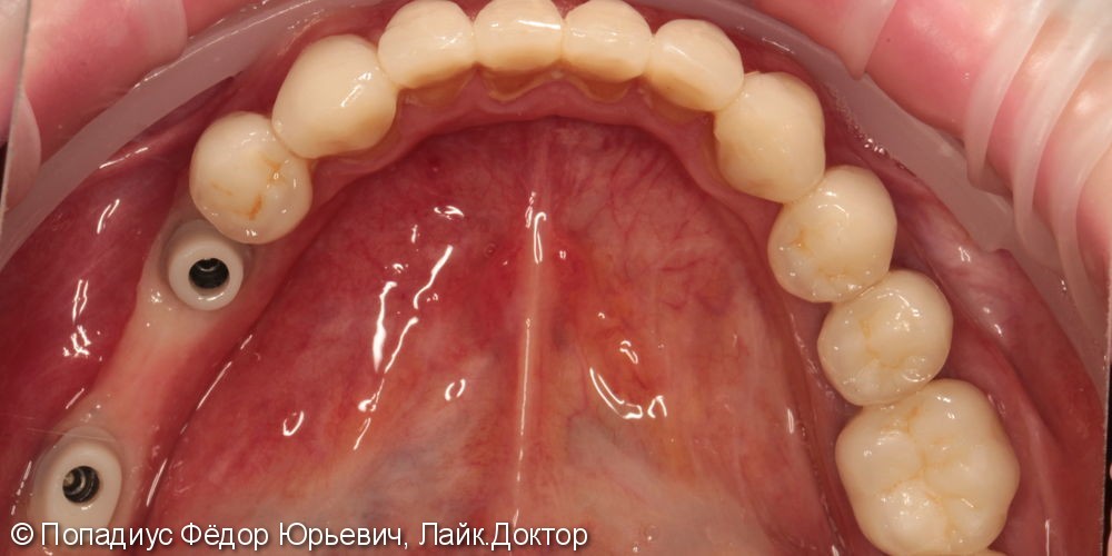 Протезирование жевательных зубов на имплантатах израильской фирмы MIS - фото №2