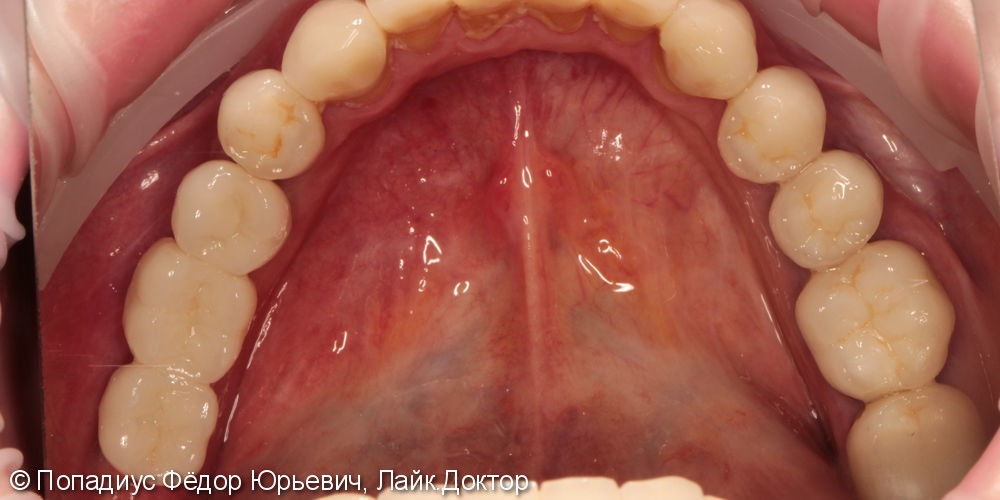 Протезирование жевательных зубов на имплантатах израильской фирмы MIS - фото №3