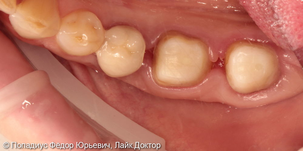 Восстановлений сильно разрушенных зубов - фото №2