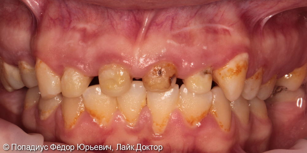 Коронки из диоксид циркония на передние, верхние зубы - фото №1