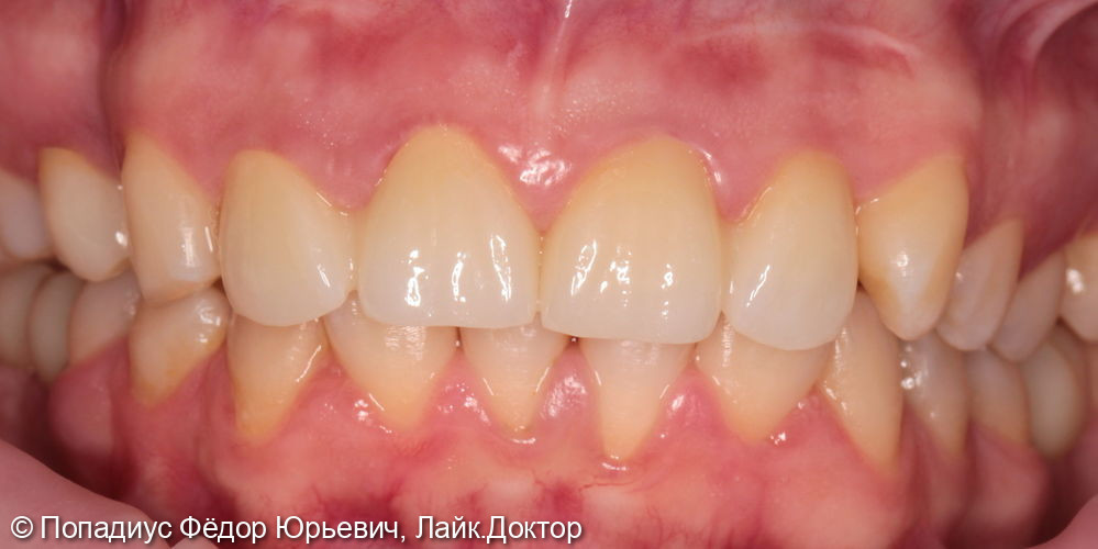 Коронки из диоксид циркония на передние, верхние зубы - фото №2