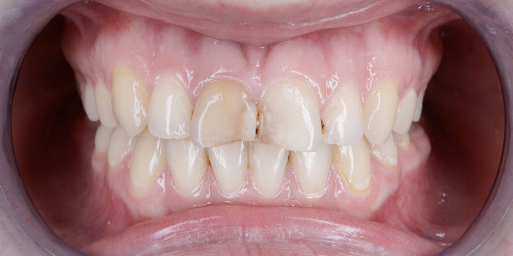 Изготовление виниров на 2 центральных зуба верхней челюсти - фото №1