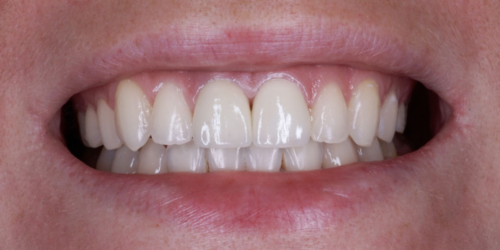 Изготовление виниров на 2 центральных зуба верхней челюсти - фото №2
