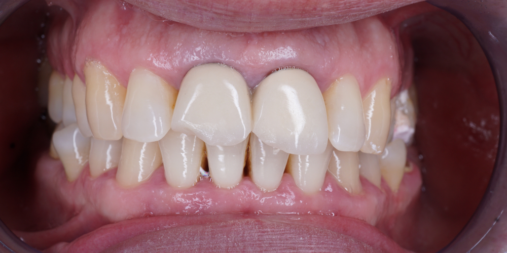 Протезирование двух зубов из диоксида циркония - фото №1