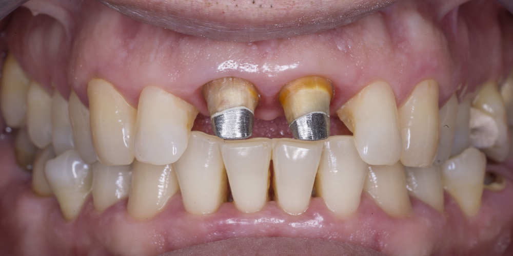 Протезирование двух зубов из диоксида циркония - фото №2