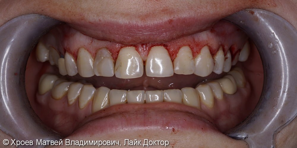 Проведение комплекса процедур для улучшения эстетического внешнего вида зубов - фото №1