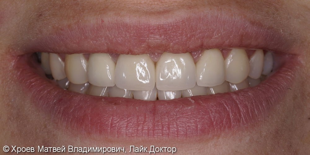 Проведение комплекса процедур для улучшения эстетического внешнего вида зубов - фото №4